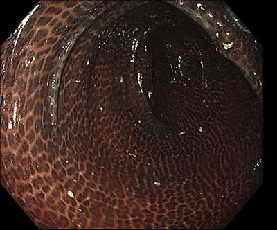 Case report: Melanosis coli combined with colon cancer, causality or coincidence?